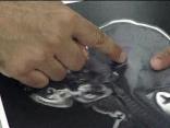 Baby Saved After Risky Surgery