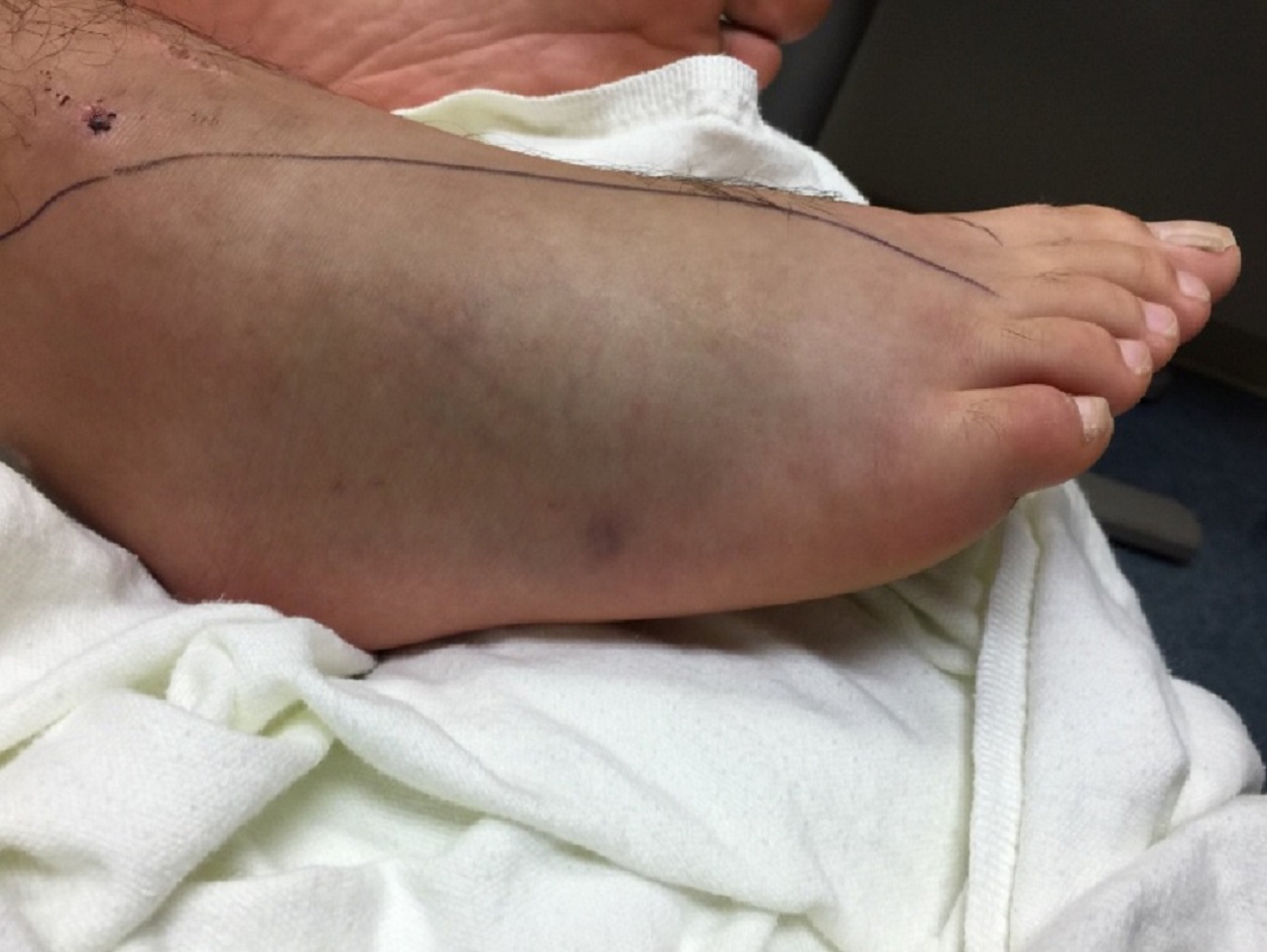 Miami-Dade Fire Helps Boy Bitten By Venomous Snake