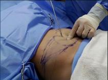 Doctor in Lipo Death Still Performing Surgeries