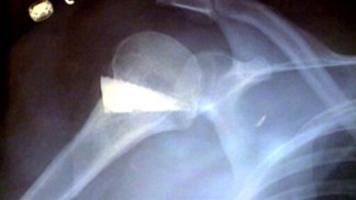 Woman Finds Knife Shard in Back 5 Years After Attack