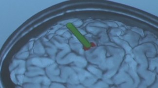New Laser Treatment for Seizures in Children