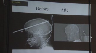 Teen Recovers From Spear Shot In His Head