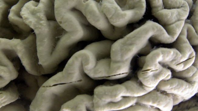 Another failure in search for treatment to slow Alzheimer's