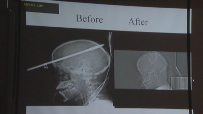 Yasser Lopez’s injury astonished the experienced team at Ryder Trauma Center in Miami. Lopez was accidentially shot in the head with a spear by a friend. On Monday, he is leaving intensive care and will eventually be moved to rehabilitation for about two or three months. Dr. George Garcia, an army trauma surgeon, called it a 