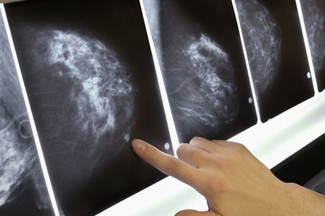 New Breast Cancer Recommendation Baffles Women