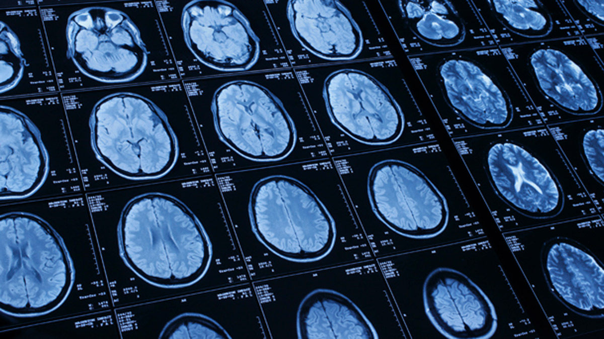 DBS Therapy May Help Fight Symptoms of Parkinson's