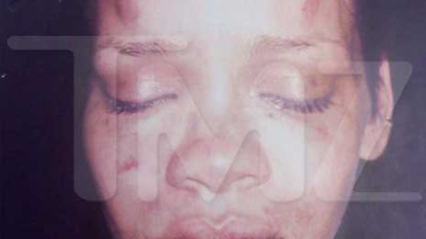 022009 Rihanna bloody bruised
