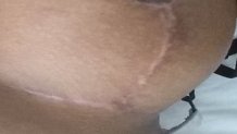 040617 breast implant scar