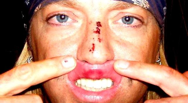 061109 Bret Michaels injury