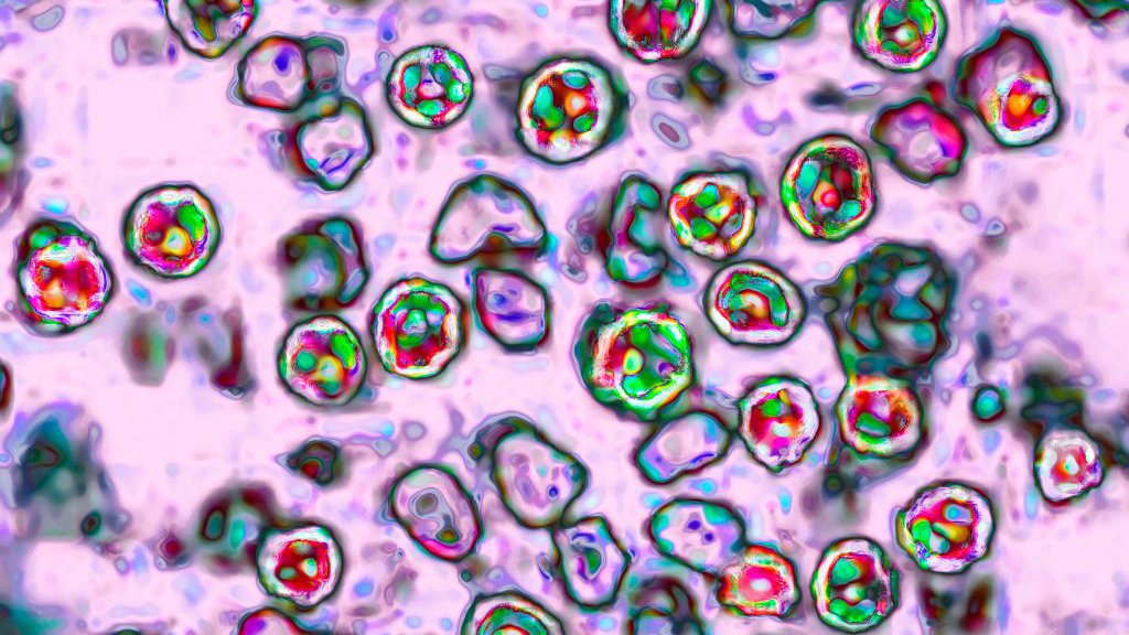 Pennsylvania's measles outbreak is the country's largest in three decades