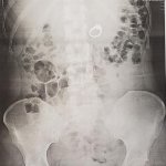 Swallowed Ring Xray