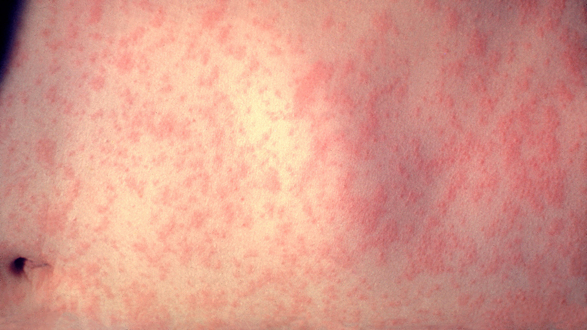 “Measles Outbreak at Broward County Elementary School Under Investigation by Florida Department of Health” – NBC 6 South Florida