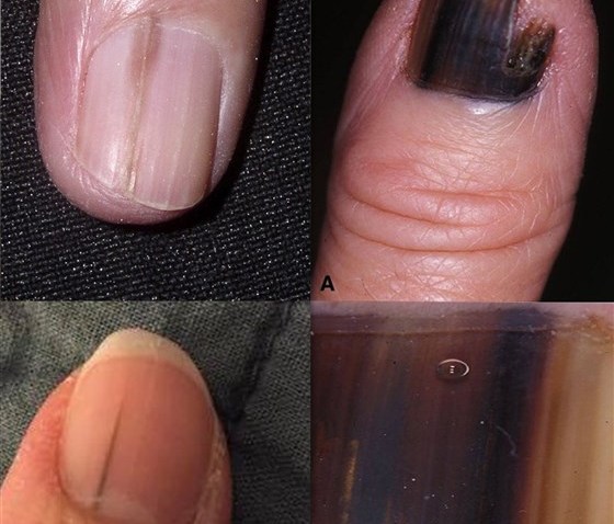 nail-melanoma-today-square-190408_910ede9535c926304e70ed57aaaf936a.fit-560w