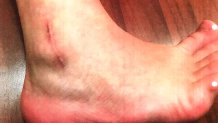 up close of ankle injury from trampoline park