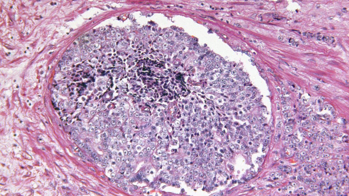 Doctors Say Renaming Low-Grade Prostate Cancer Could Lead to Better Treatment Choices - Vimarsana News
