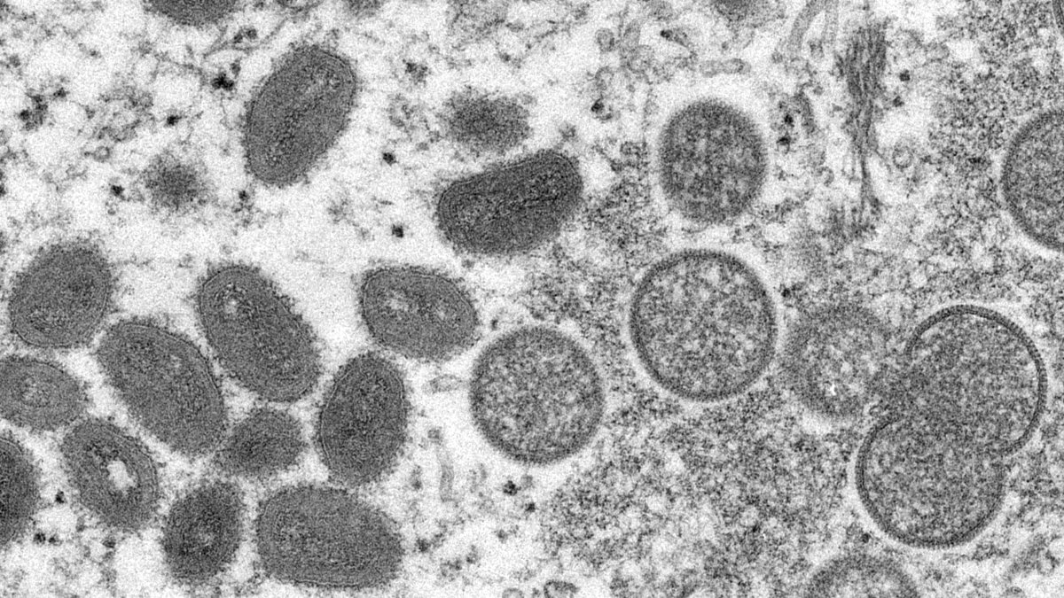 Un caz de variolă a maimuței a fost raportat în comitatul Broward – NBC6 South Florida