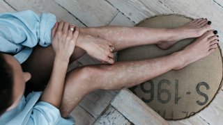 Young woman relaxed on a stool, unafraid to show her psoriasis