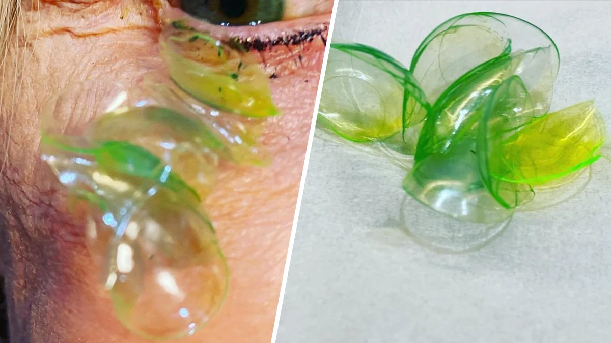 Woman Had 23 Contact Lenses Stuck Under Her Eyelid, Doctor Says – NBC 6 South Florida - Vimarsana News