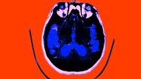 Obesity and Alzheimer's Disease Cause Similar Brain Changes, Study Finds