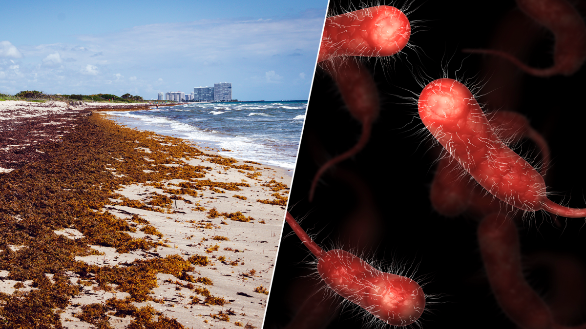 ‘Flesheating’ bacteria vibrio vulnificus linked to 5 deaths in Florida NBC 6 South Florida