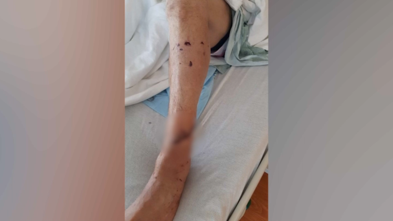 South Florida man recounts crocodile attack at Everglades National Park