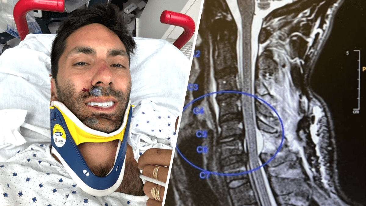 'Catfish' host Nev Schulman shares he broke his neck in a bike accident