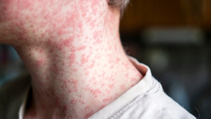 A person with measles.