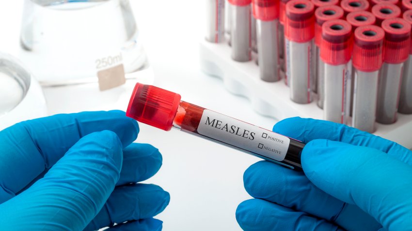 The anti-vaccination movement, contagious disease and the antivaxer campaign concept theme with doctor, nurse or phlebotomy technician holding blood sample in a test tube, being tested for Measles