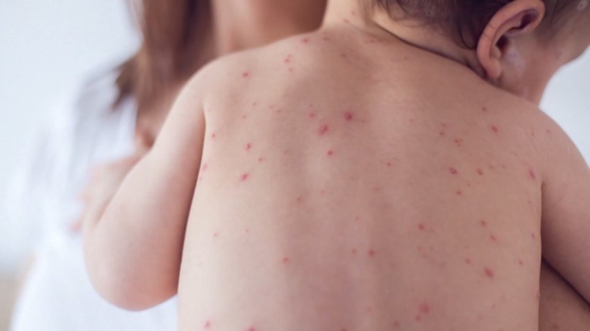 What you need to know about the MMR vaccine