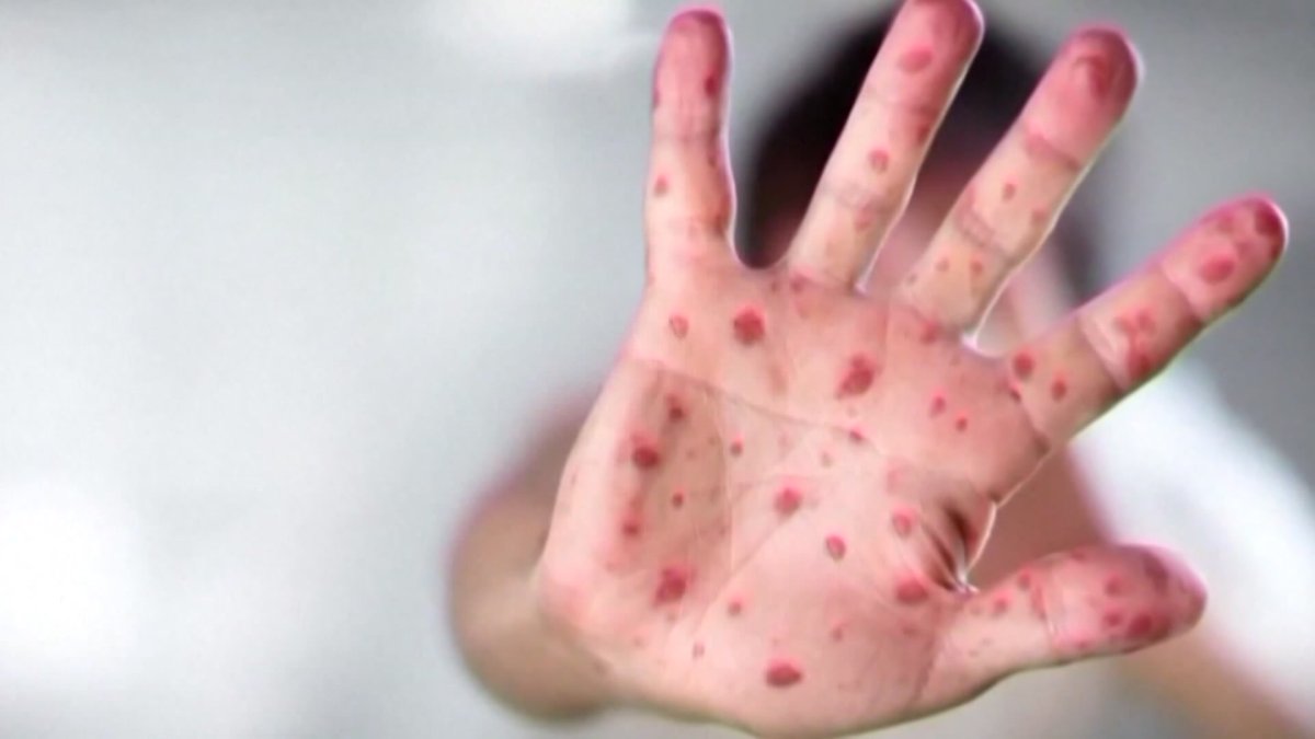 Florida ranks 3rd for the most measles cases in the U.S.: CDC