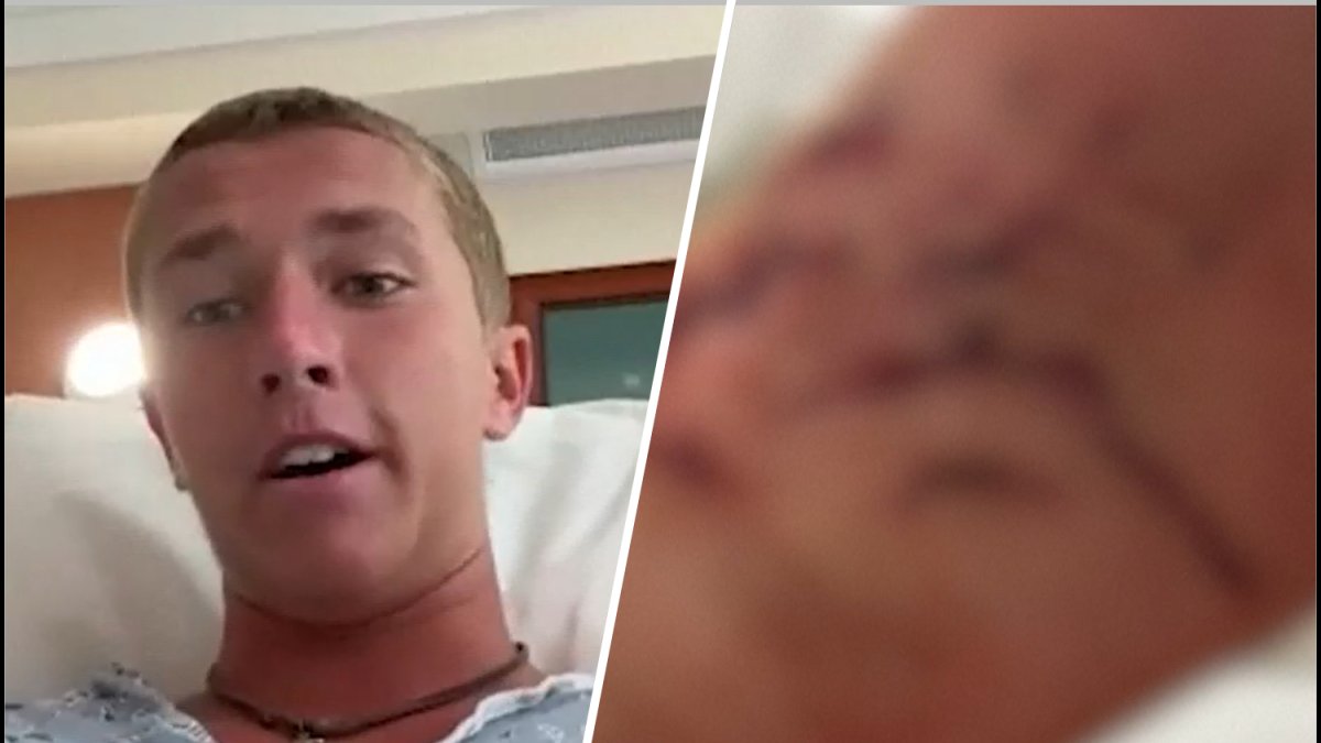 Florida surfer survives shark bite, vows to get back in the water