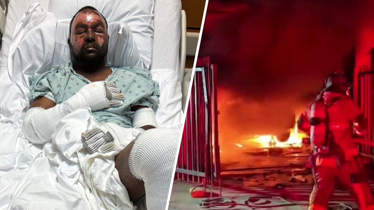 A man has a long road to recovery after he was badly burned in a fire at his auto shop in Opa-locka last week.