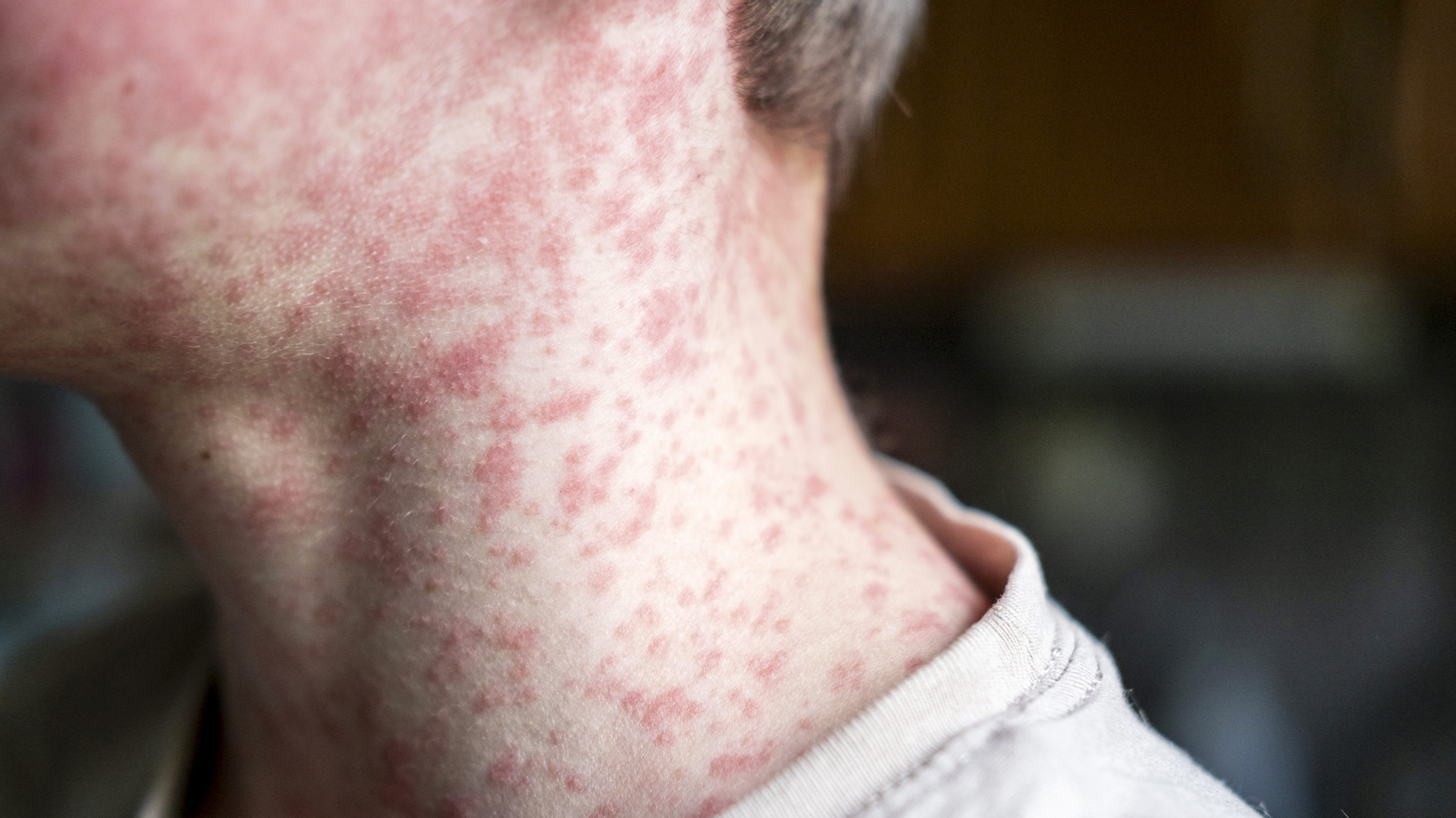 New measles cases in South Carolina put U.S. on the verge of losing elimination status