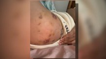 A South Florida woman says she had to go to the hospital after getting lip fillers, Botox and buttock injections last year from someone who is now charged with performing the procedures without a license.
