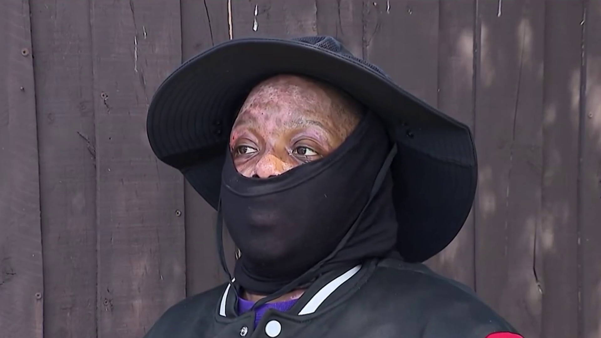 ‘She watched me burn': Woman recovering after roommate allegedly set her on fire in Hollywood