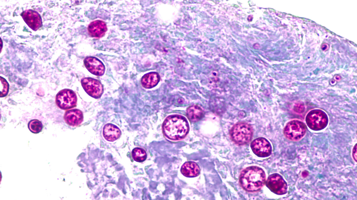 Cases of diarrhea parasite nearly triple in Miami-Dade in a week; Monroe sees 1st case