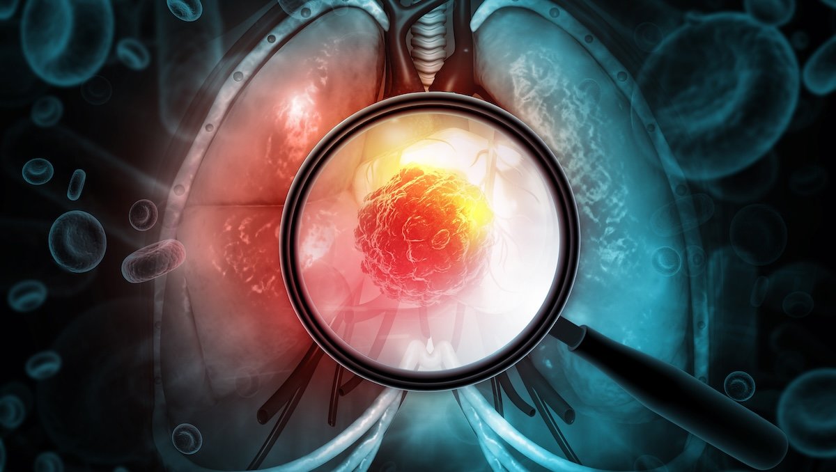 What is adenocarcinoma? A doctor explains the lung cancer after Pope Leo's diagnosis