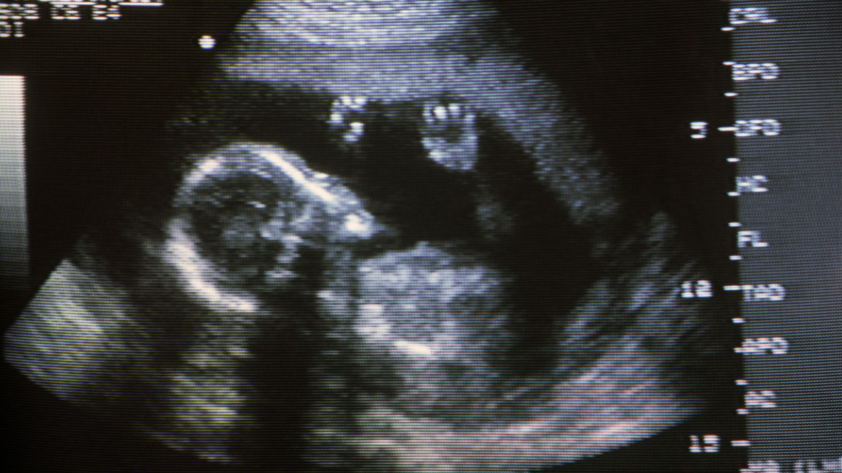 New Bill Would Ban Abortions in Florida After Heartbeat Is Detected